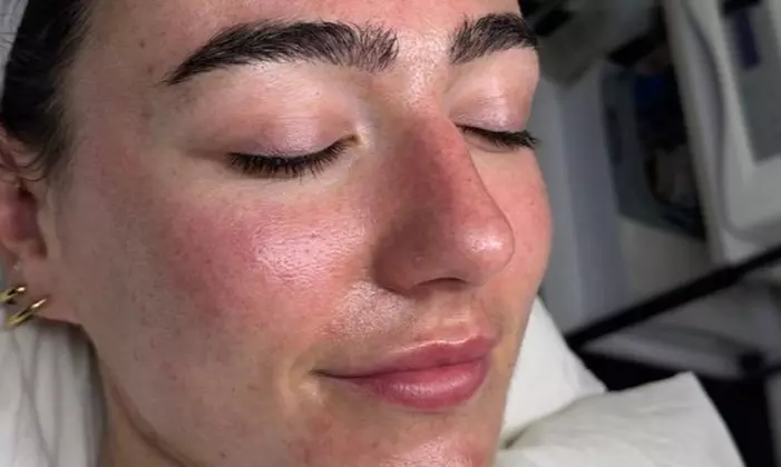 Zena Aesthetics Offers One or Three Polynucleotide HA Microneedling Treatment (Up to 40% Off) - Primary Image