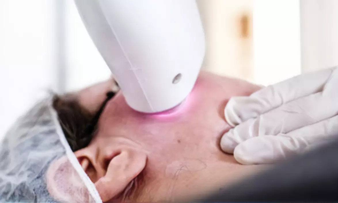 Depilación con láser de diodo en zona a elegir para 1 persona