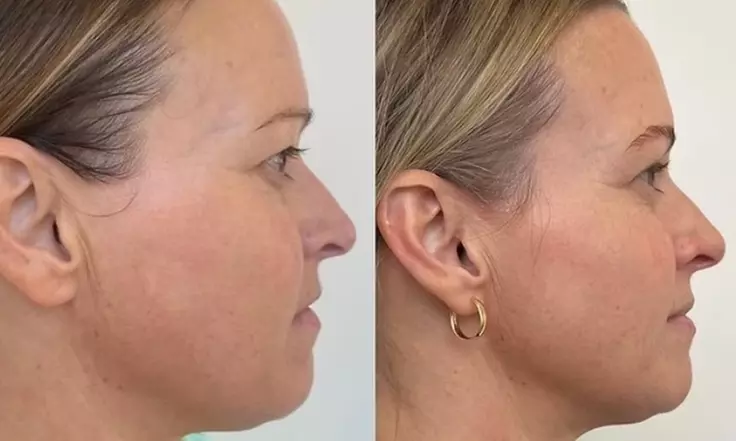 64% Off Non-Invasive HIFU & Luxe Facial Treatments