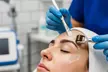 1, 2, or 3 Sessions of Chemical Peel & Skin Needling Or Deep Facial Cleansing and Chemical Peel (Up to 53% Off) - Image 2