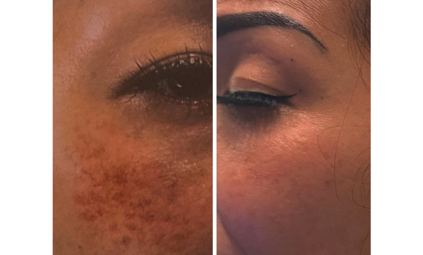 Image 2: Up to 52% Off on Laser Skin Resurfacing at Hang's Spa