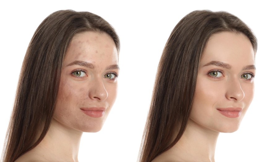 Image 2: Enhance Your Skin with One, Three or Five 60 Min Chemical Peel Facials