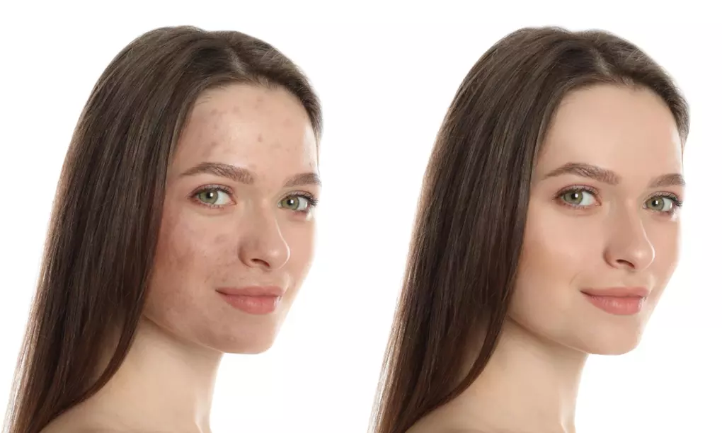 Enhance Your Skin with One, Three or Five 60 Min Chemical Peel Facials