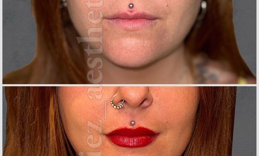 Image 2: Up to 57% Off on Injection - Dermal Filler at Diez Anti-aging Aesthetics