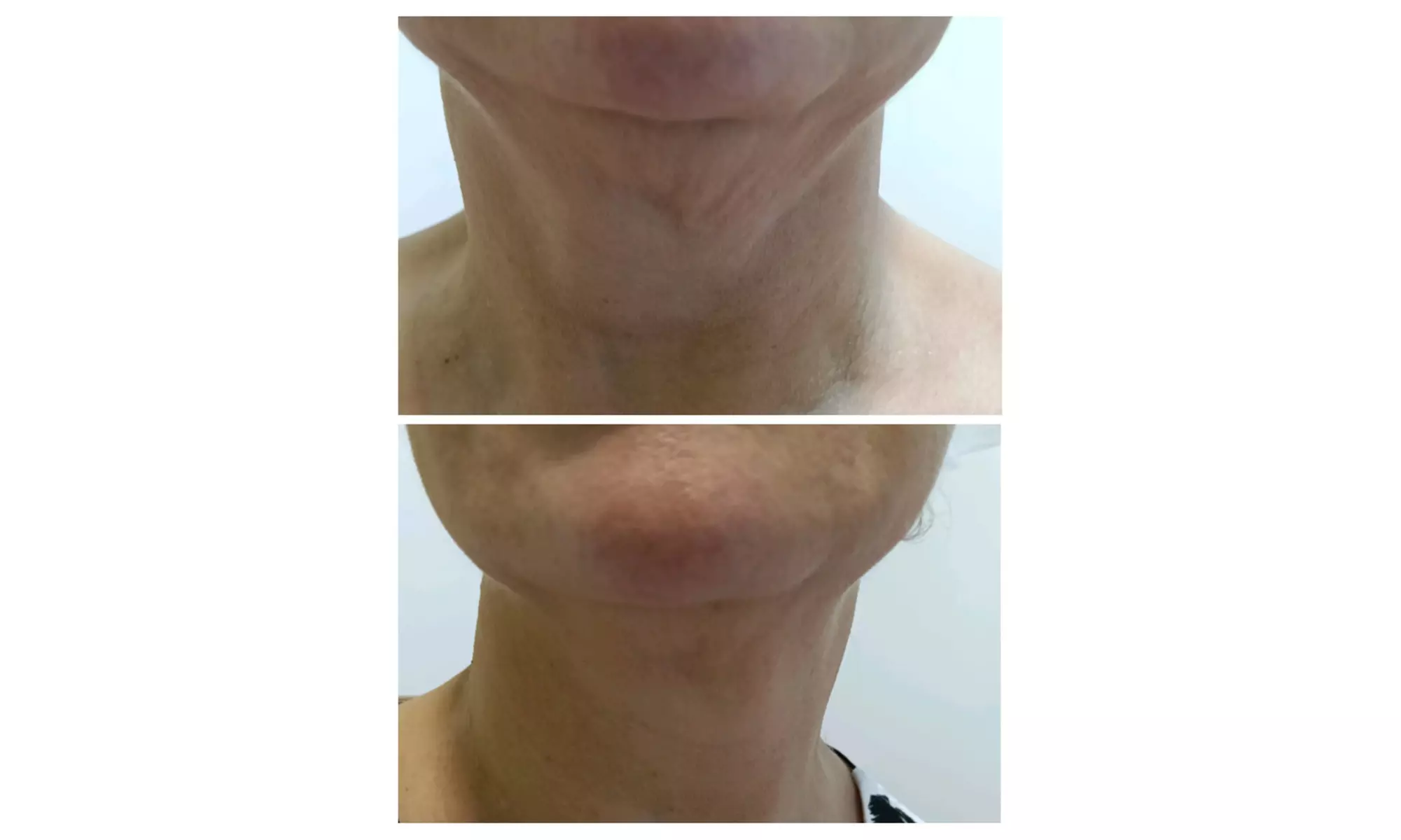 Tratamiento HIFU V10 MAX INDOLORO en rostro para 1 persona