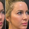 Image 1: Skinvive Hydration & Radiesse Contour Fillers for Radiant Skin