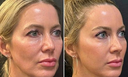 One Syringe of Skinvive Fillers 1.0mL) - iGlow Aesthetics
