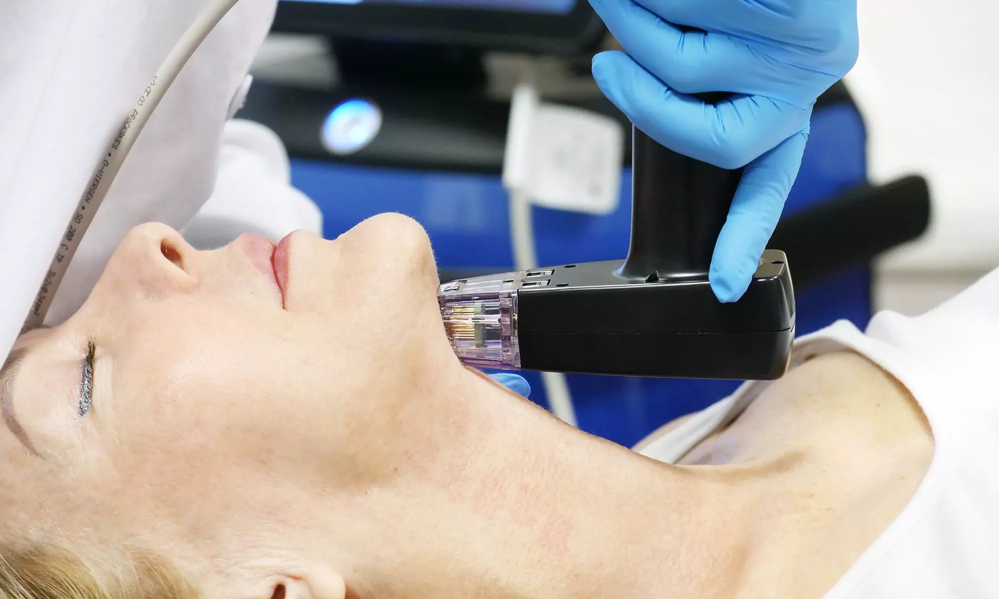 Revitalize your Glow at V2 Medspa! 1, 2, or 3 RF Microneedling Morpheus8 Sessions - Face Only (Up to 50% Off) - Primary Image