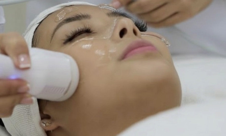 Image 1: 2 o 4 sesiones de crioterapia en rostro completo y papada para 1