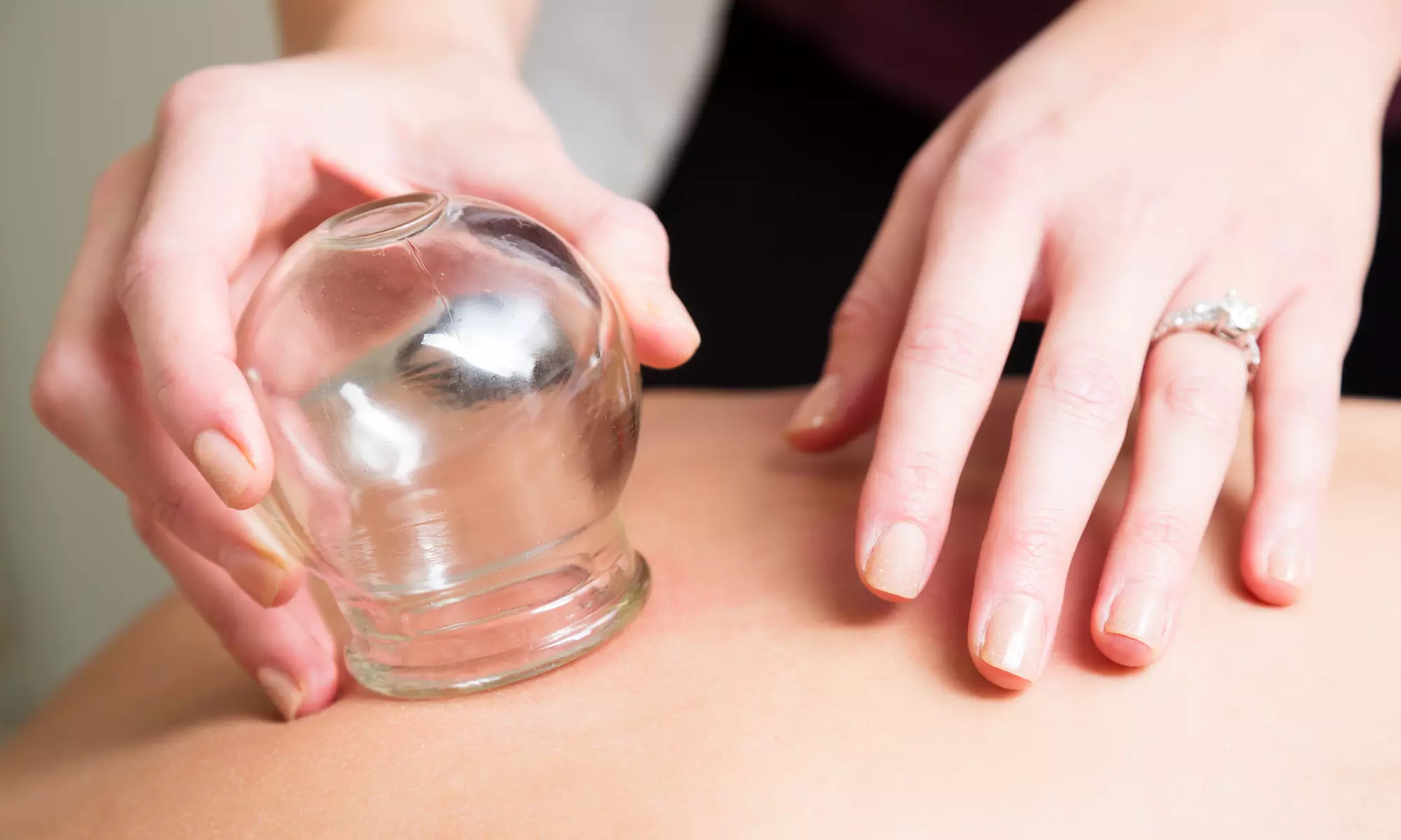 One or Two Cupping w/ Massage and Consultation or Initial Acupuncture (Up to 57% Off) - Primary Image