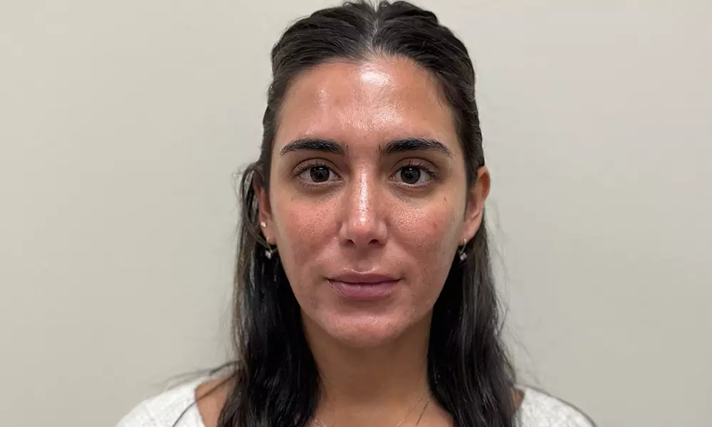 Enhance Your Lips with Half or Full Syringe Lip Filler (Up to 50% Off)