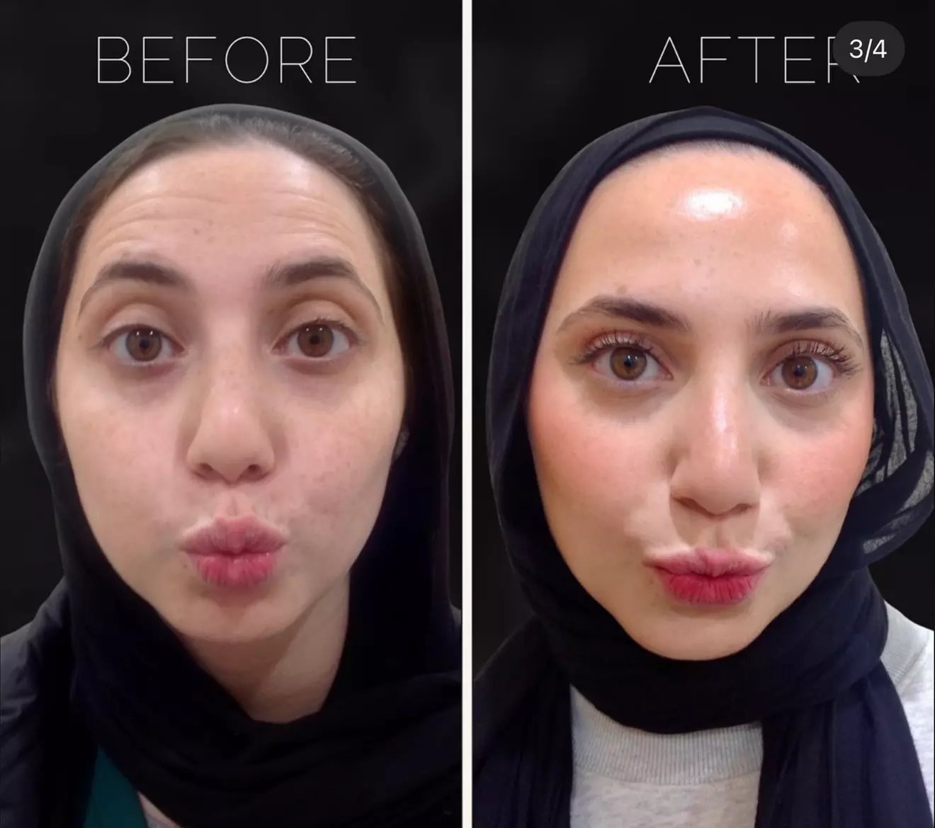 BOTOX® at Chicago Institute of Plastic Surgery