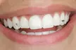 Your Covina Family Dentistry Offers Swarovski  Tooth Gem Placement for 1, 2 or 3 Teeth (Up to 90% Off) - Second Medium