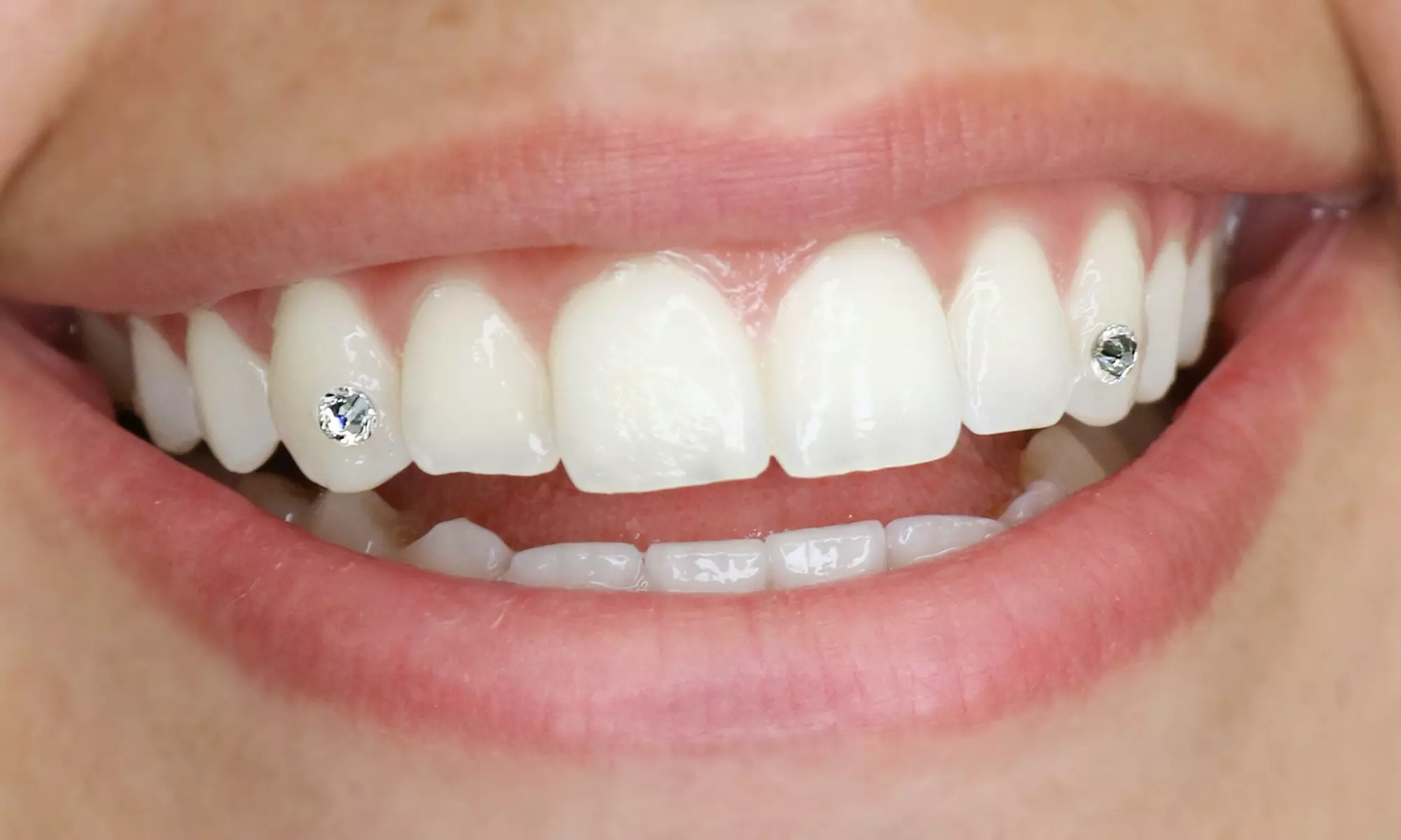 Sparkling Smile with Swarovski  Tooth Gem Placement for 1 2 or 3 Teeth
