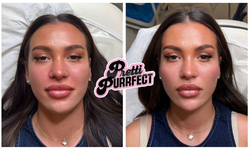 Image 8: One or Two Profhilo® Skin Revitalising Booster Sessions