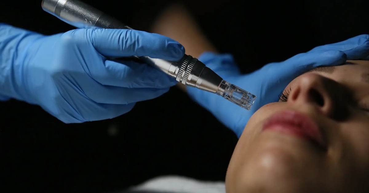 Tratamiento de microneedling con vitaminas en rostro, cuello y escote en Barcelona