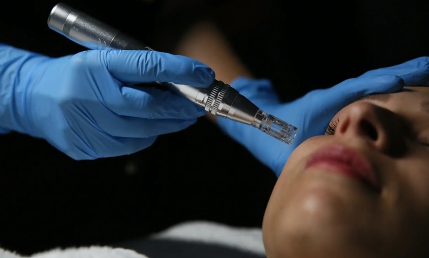 Image 1: Microneedling con vitaminas en rostro, cuello y escote para 1 persona