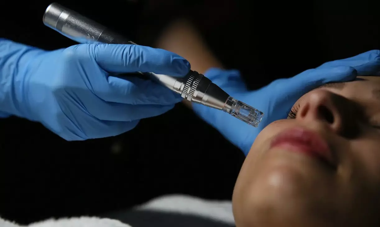 Microneedling con vitaminas en rostro, cuello y escote para 1 persona