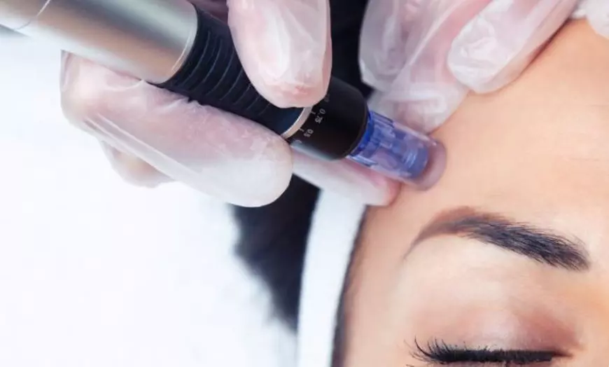 Image 2: Revitalize with One or Two Sessions of Microneedling and LED Therapy!