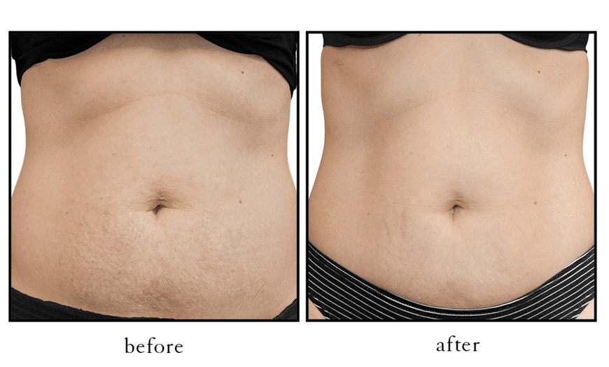 Image 2: Up to 54% Off on Laser Skin Resurfacing - Branded at Body Radiance Med Spa