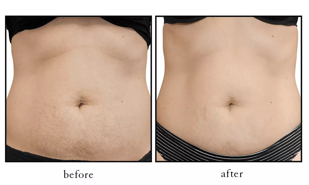 Up to 49% Off on Laser Skin Resurfacing - Branded at Body Radiance Med Spa - Second Medium