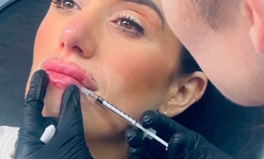 Image 4: Lip Filler and Enhancement Options Using Evolysse