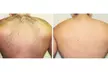 A-ONE Laser Clinic: Three Laser Hair Removal Sessions for Small, Medium or Large Area (Up To 75% Off) - Second Medium