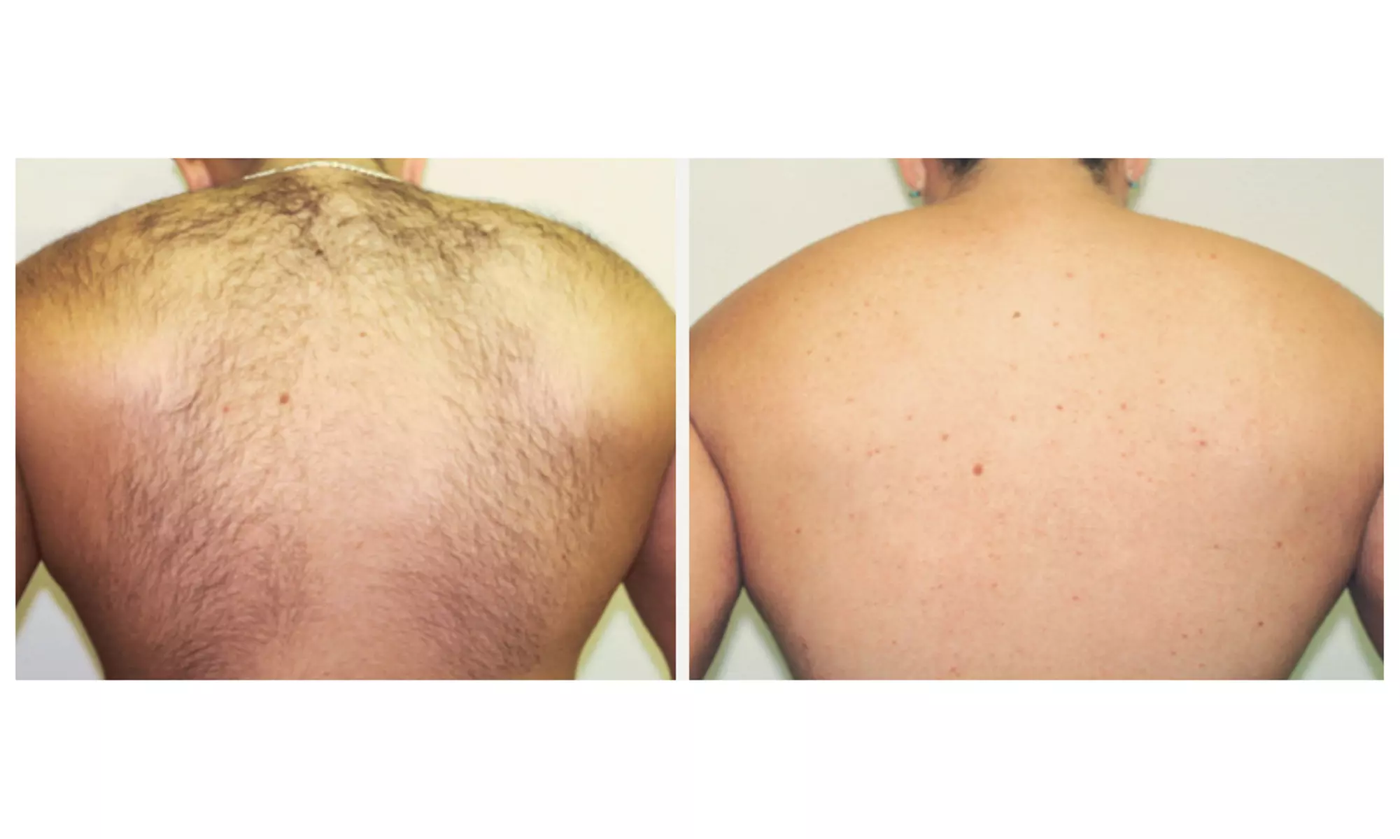 3 Laser Hair Removal Sessions for Small, Medium or Large Area