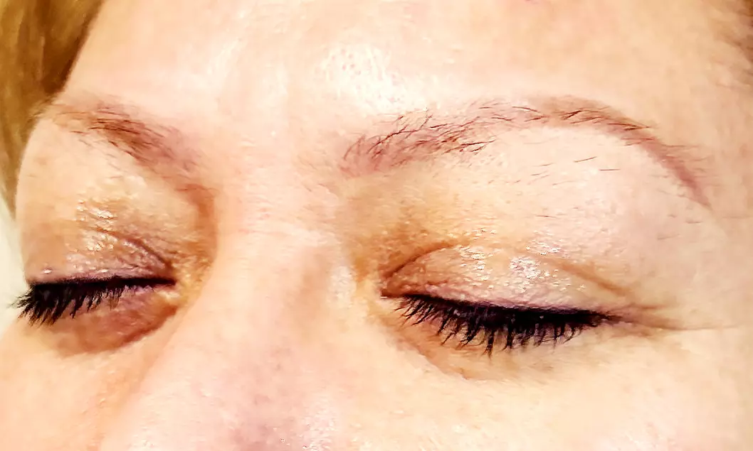 Transform Your Features with Brow Lift, Lip Flip, or 20 or 30 Units of Xeomin (Up to 50% Off) - Second Medium