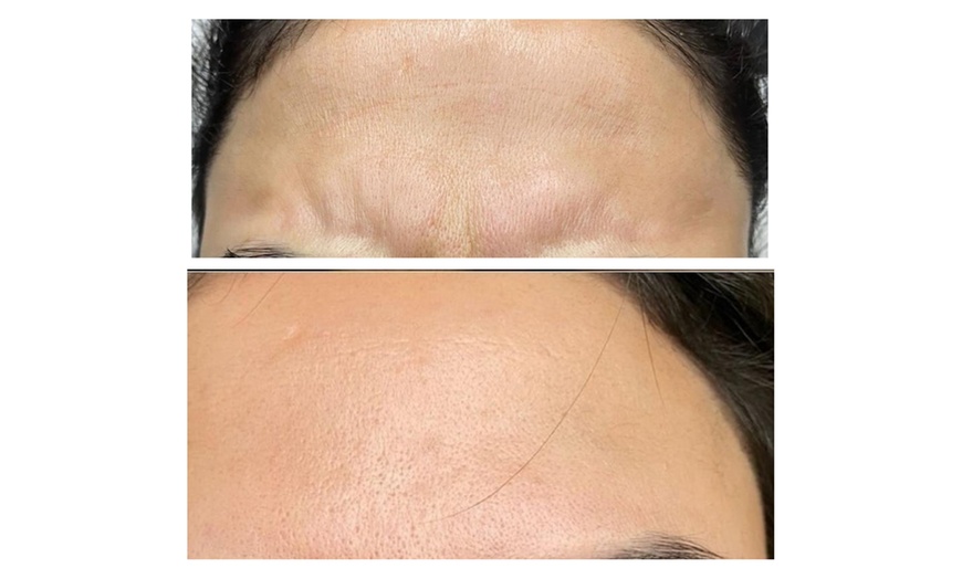 Image 5: Up to 50% Off on Injection - Filler and Freezer at Eleganza Aesthetics