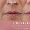 Image 2: HIFU Brow Lift & Fine Line Smoothing (No Needles)