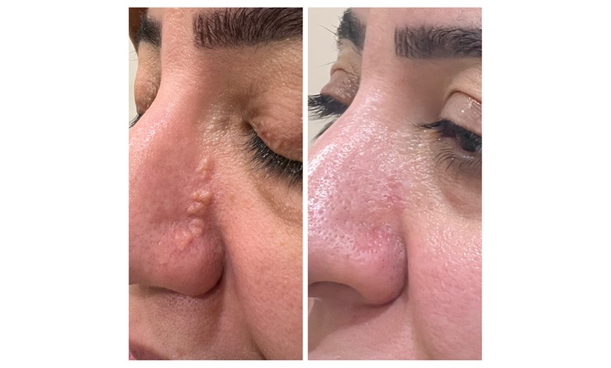 Image 6: One or Two Mole or Skin Tag Removal for Smooth Clear Skin