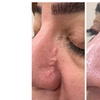 Image 6: One or Two Mole or Skin Tag Removal for Smooth Clear Skin