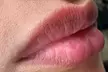 1 sesión de rehidratación de labios con dermapen y vitaminas para 1 persona con 30% de descuento - Second Medium