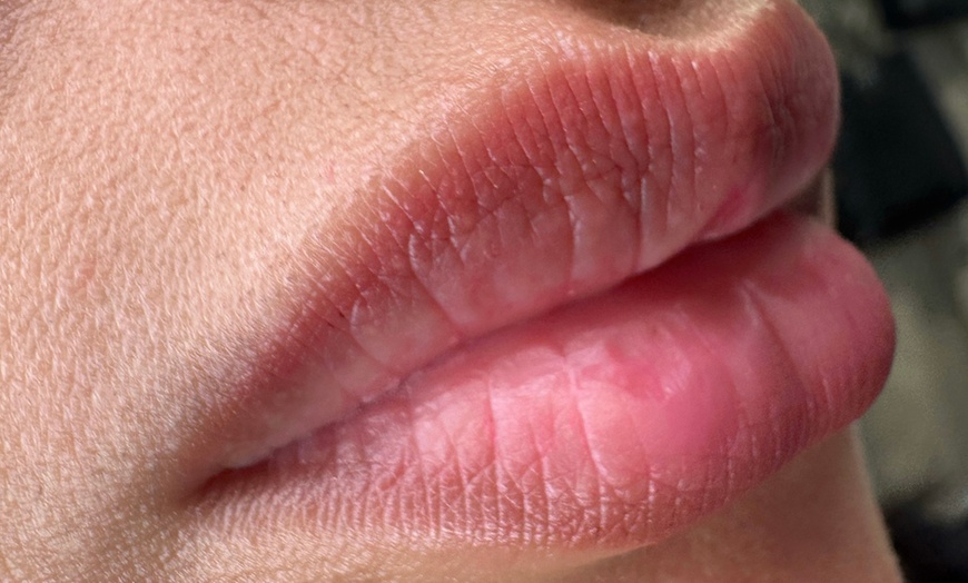 Image 3: Sesión de rehidratación de labios con dermapen y vitaminas para 1 