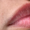 Image 3: Sesión de rehidratación de labios con dermapen y vitaminas para 1 