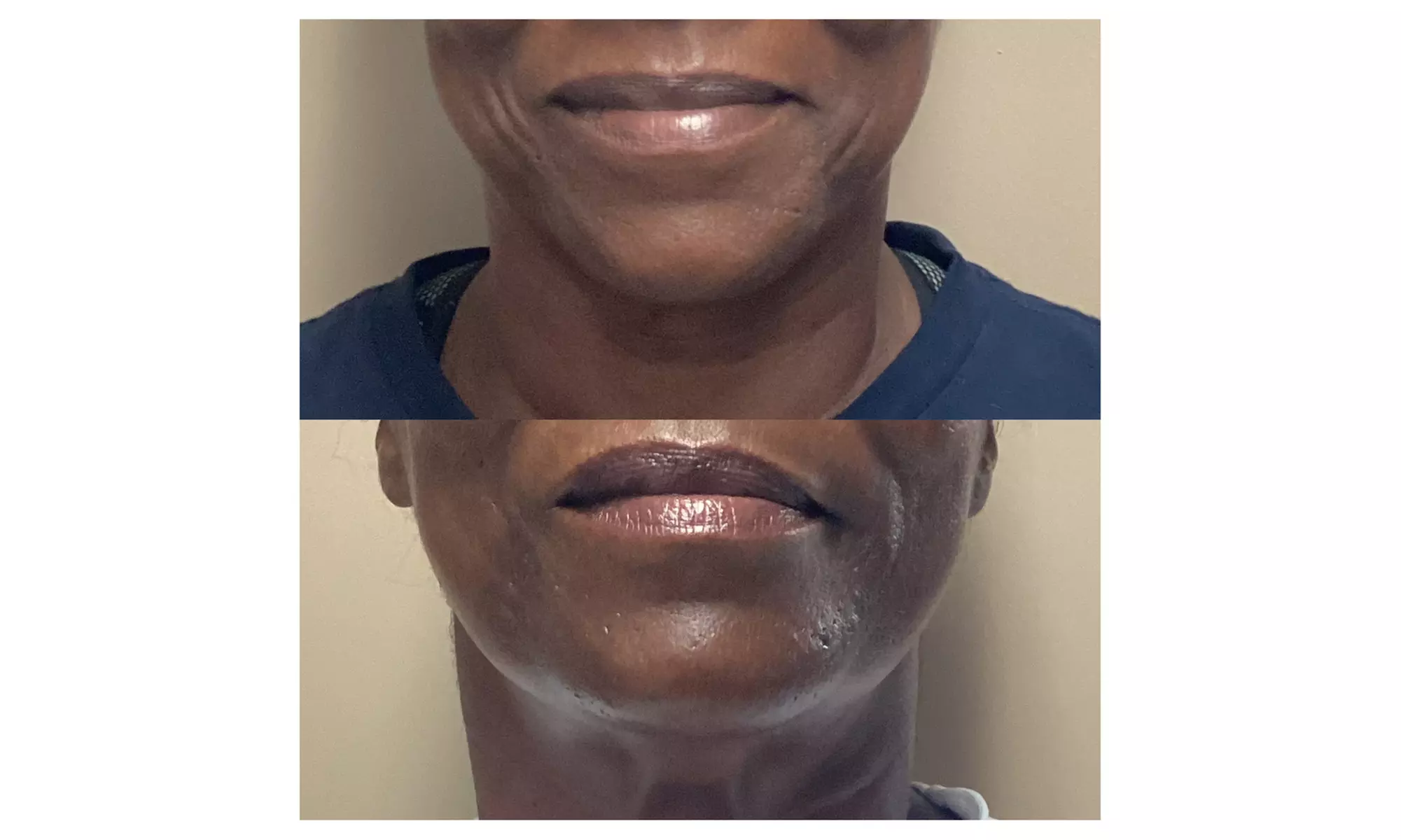 Achieve Natural Beauty with Lip Filler Options 