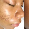 Image 4: Chemical Peels & Facials: VI, BioRePeel, SENSI, Acne and Glass Skin