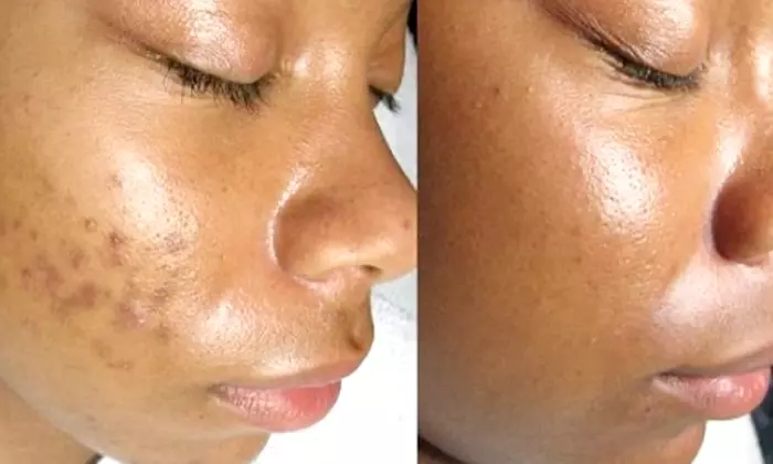 Chemical Peels & Facials: VI, BioRePeel, SENSI, Acne and Glass Skin