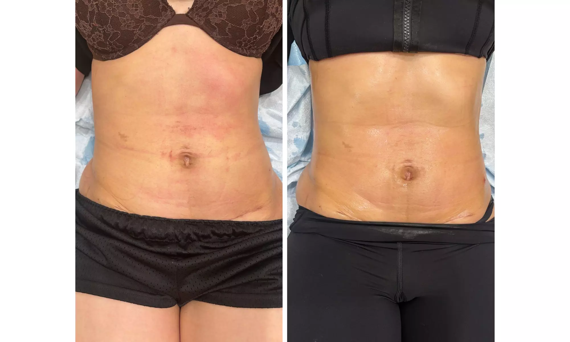 Try body sculpting and velashape for cellulite reduction