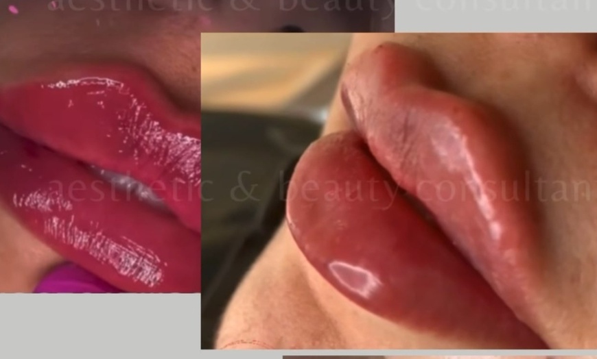 Image 3: Achieve a Natural Look with Dermal Filler 0.5ml, 1ml, or 2ml