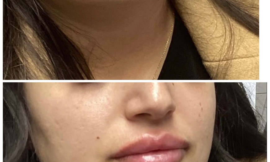 Image 2: Refresh with One Syringe of RHA 2, RHA 3, or Revanesse Versa