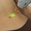 Image 21: Smooth, Hair-Free Skin with Laser Hair Removal at Semper Laser