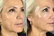 Reveal Glowing Skin with One or Two VI Peel at River Oaks Galleria Medspa (upto 54% Off) - Second Medium