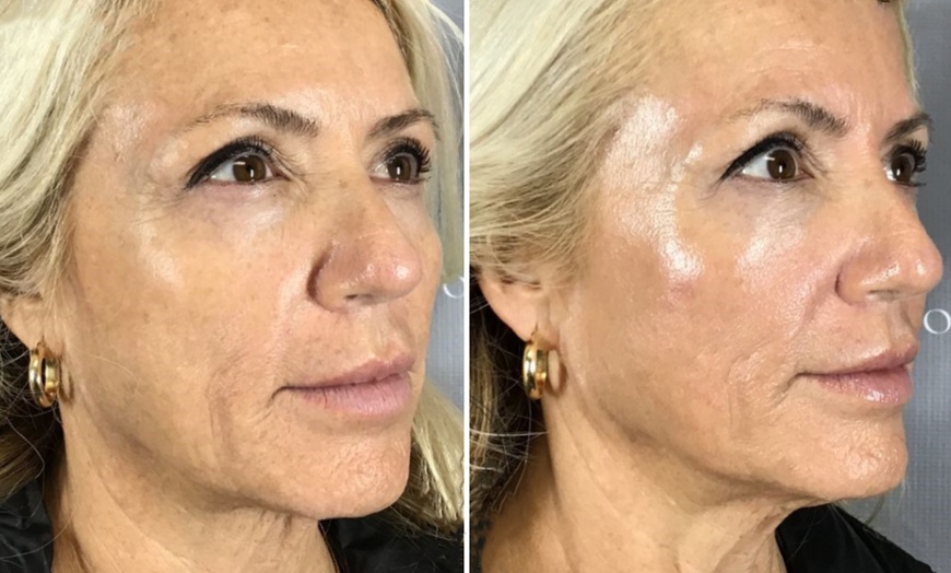 Image 5: Reveal Glowing Skin with One or Two VI Peel