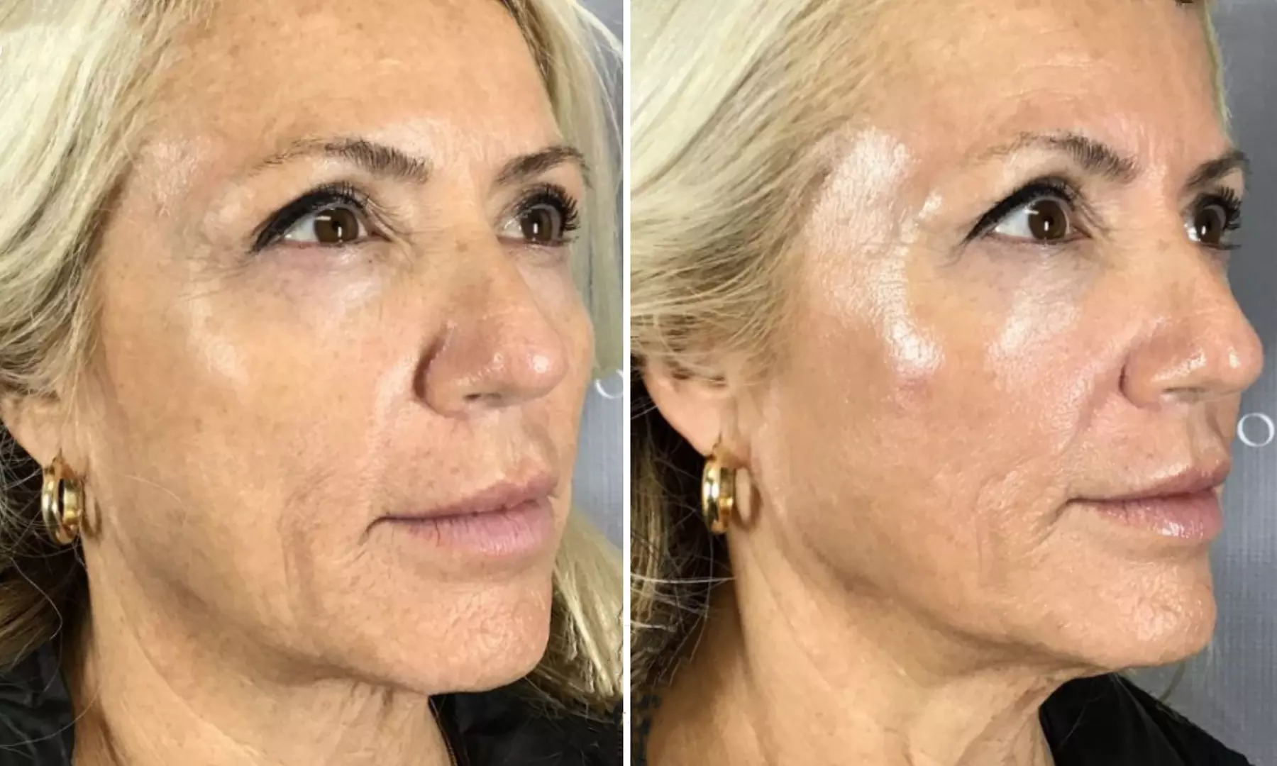 Reveal Glowing Skin with One or Two VI Peel