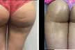 Experience Perfections Body Sculpt's Non-Invasive Brazilian Butt Lift and Cellulite Reduction up to 65% - Second Medium