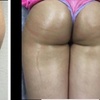 Image 2: Transform with Non-Surgical Brazilian Butt Lift Sessions