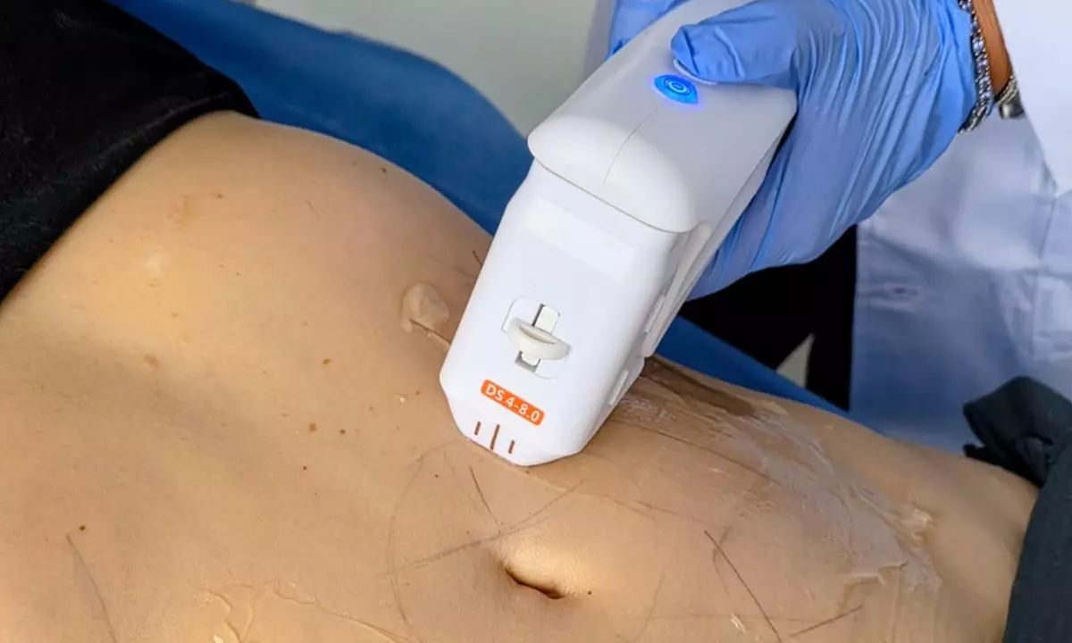 One 12D HIFU Facelift  or Skin-Tightening Treatment