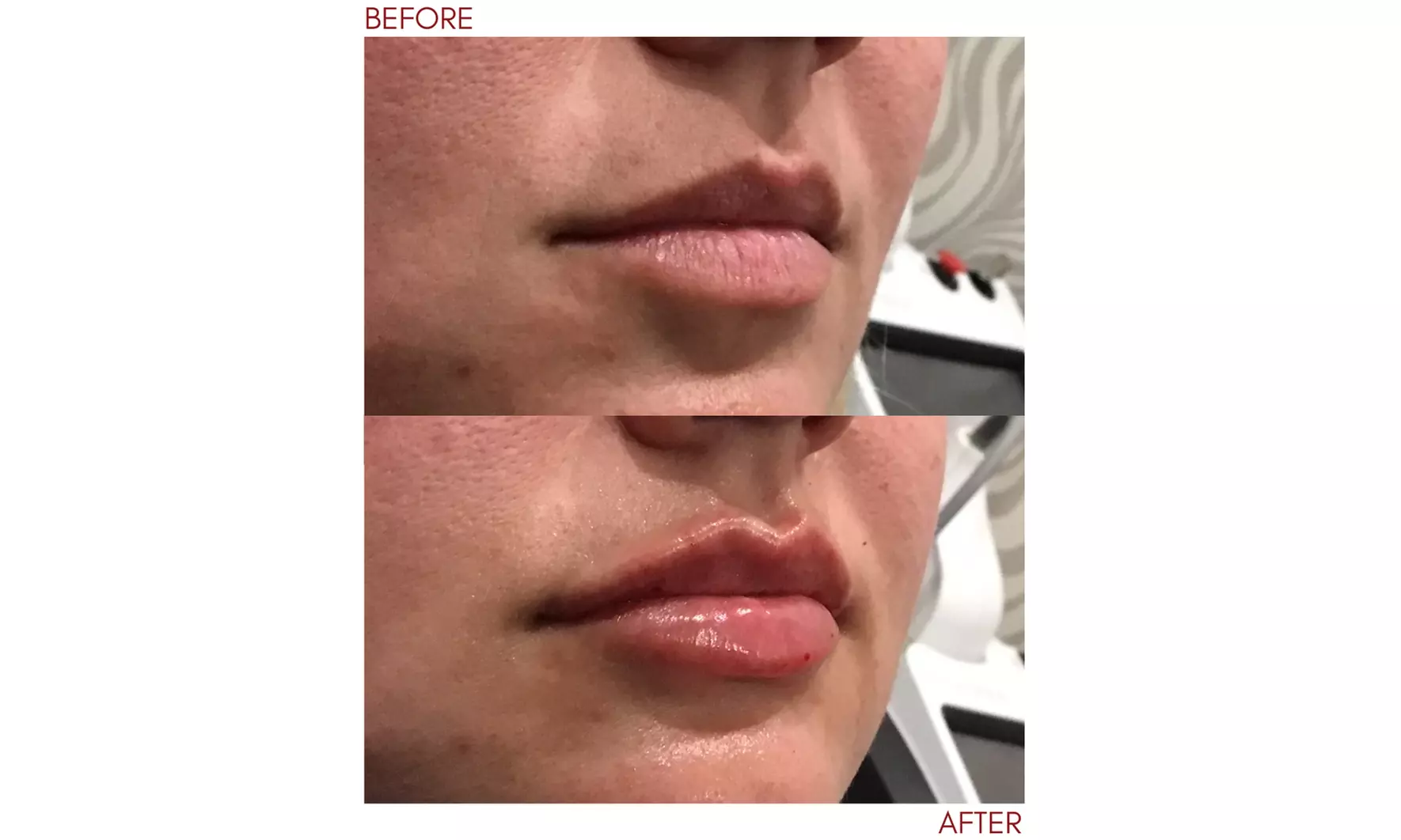 Revitalize with Juvederm Ultra or Voluma XC Syringe Options